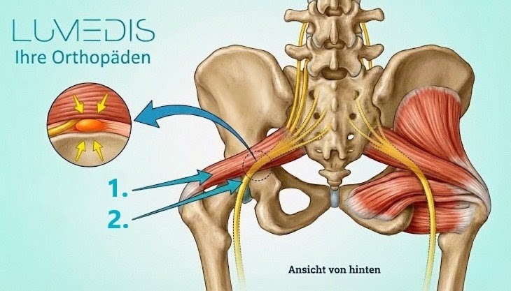 Abbildung eines Piriformis-Syndroms von Lumedis Abbildung eines Piriformis-Syndroms von Lumedis