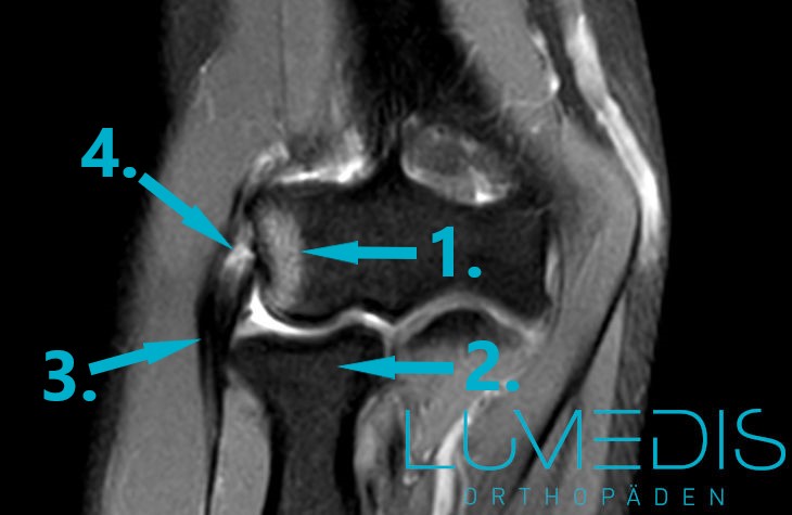 MRT eines schweren Tennisarms mit Sehnenanriss MRT eines schweren Tennisarms mit Sehnenanriss