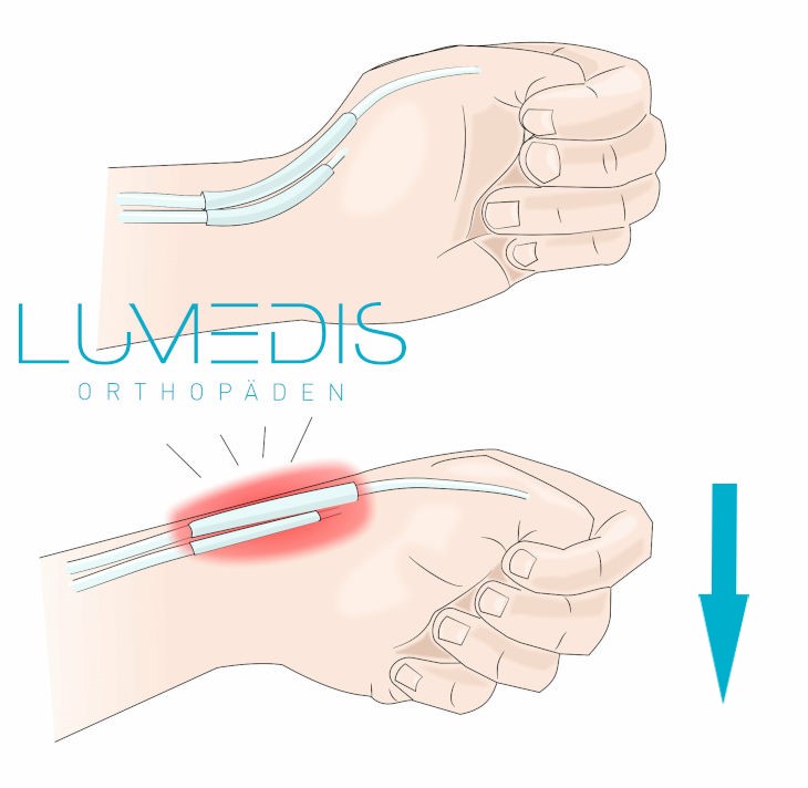 Finkelstein Test Finkelstein Test