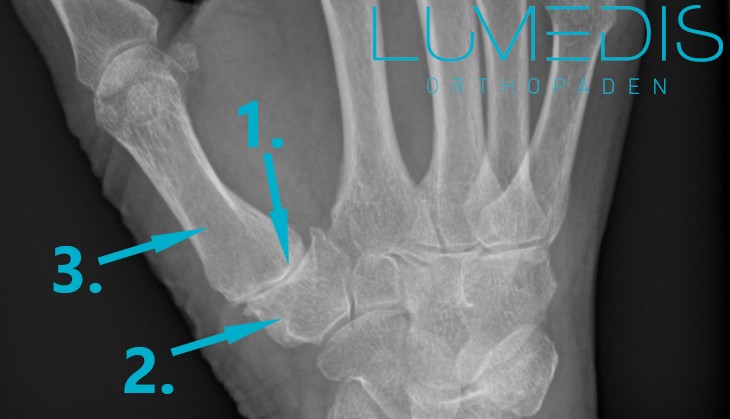 Röntgen einer Rhizarthrose (Arthrose im Daumen) der rechten Hand Röntgen einer Rhizarthrose (Arthrose im Daumen) der rechten Hand