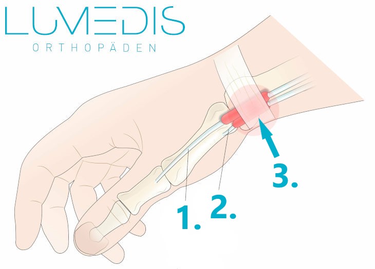 Tendovaginitis de Quervain Tendovaginitis de Quervain