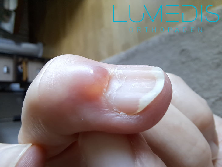 Mukoidzyste am Daumen Mukoidzyste am Daumen