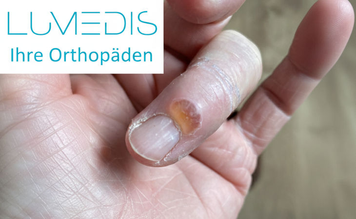 Mukoidzyste vom Finger Mukoidzyste vom Finger