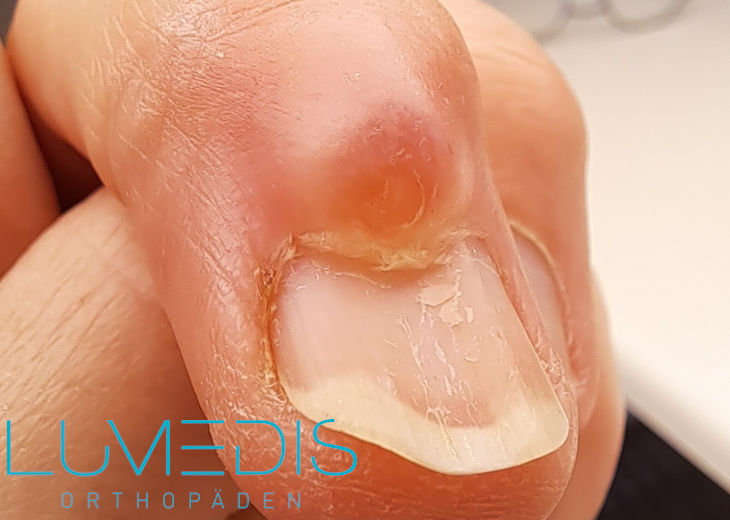 Mukoidzyste am Daumen Mukoidzyste am Daumen