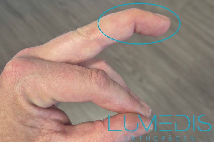 Strecksehnenriss vom linken Mittelfinger Strecksehnenriss vom linken Mittelfinger