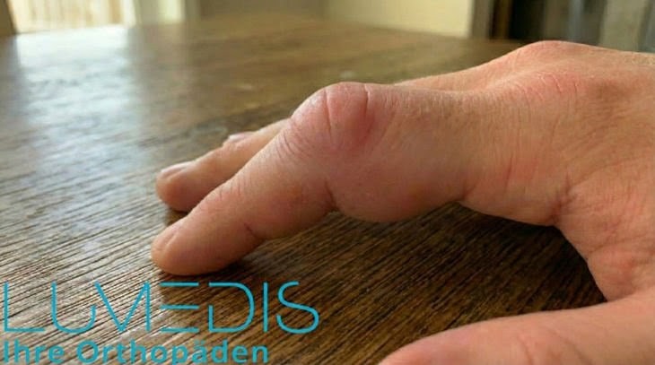 Finger ausgekugelt (Fingerluxation) Finger ausgekugelt (Fingerluxation)