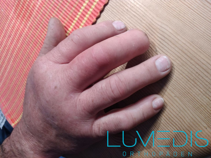 Entzündung im Mittelfinger Entzündung im Mittelfinger