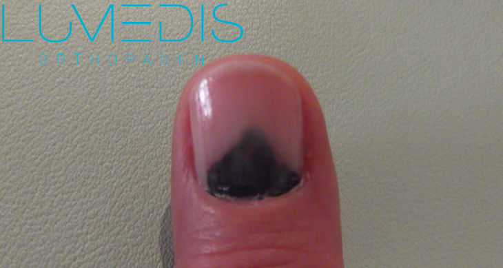 Hämatom unter Nagel Hämatom unter Nagel