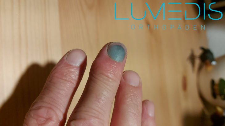 blauer Fingernagel