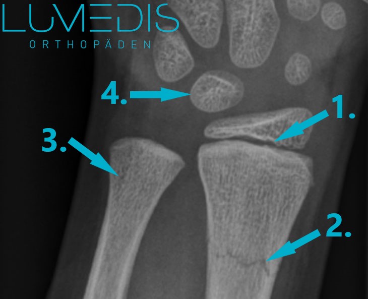 Grünholzfraktur am Handgelenk Grünholzfraktur am Handgelenk