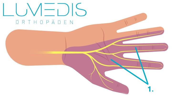 Areal der Taubheit bei einem Karpaltunnelsyndrom (CTS)