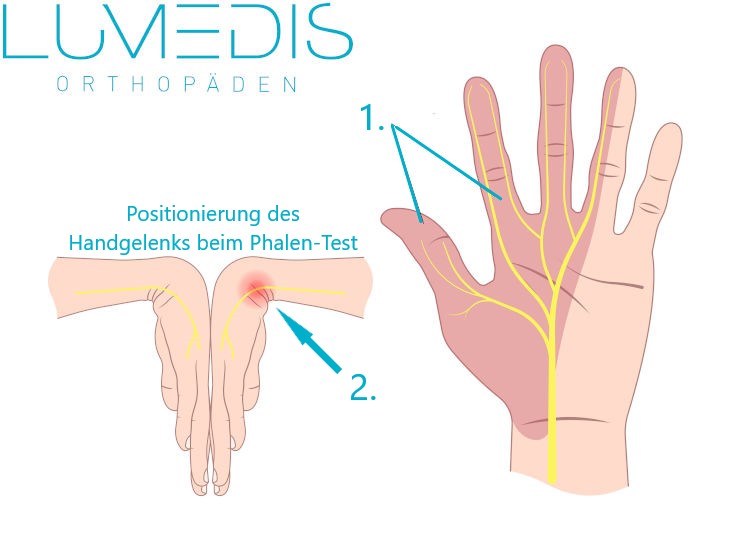 Phalen-Test bei einem Karpaltunnelsyndrom Phalen-Test bei einem Karpaltunnelsyndrom