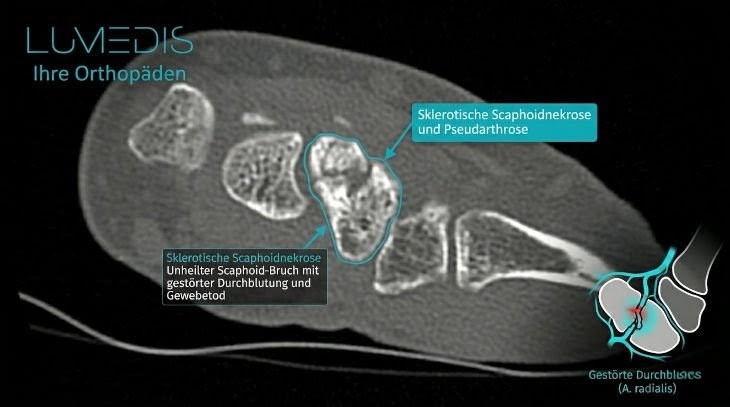 CT eines Morbus Preisers CT eines Morbus Preisers