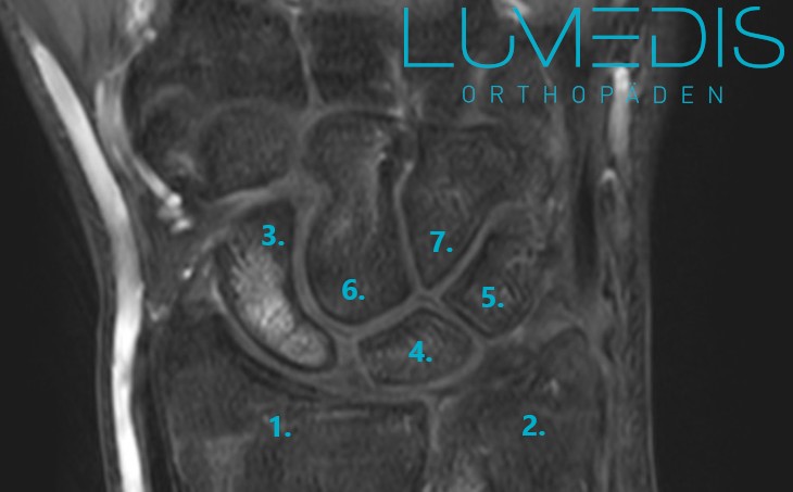 MRT der Handwurzel mit einem beginnenden Morbus Preiser MRT der Handwurzel mit einem beginnenden Morbus Preiser