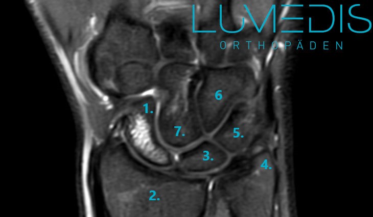 MRT einer Nekrose vom Kahnbein (Morbus Preiser) MRT einer Nekrose vom Kahnbein (Morbus Preiser)