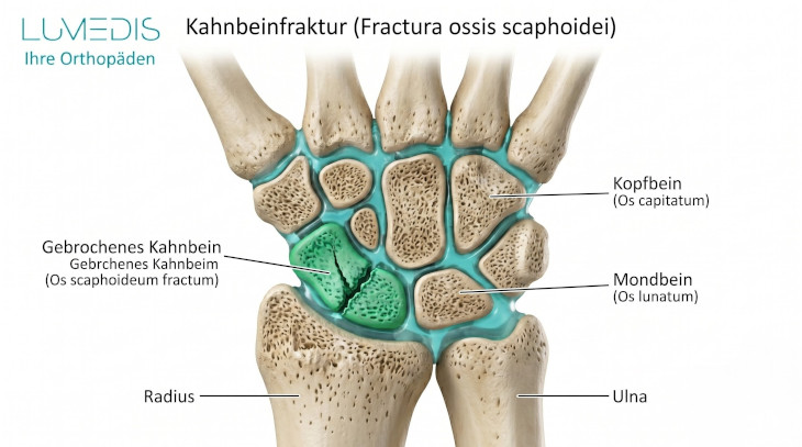 Anatomie: Kahnbein gebrochen (Kahnbeinbruch) Anatomie: Kahnbein gebrochen (Kahnbeinbruch)