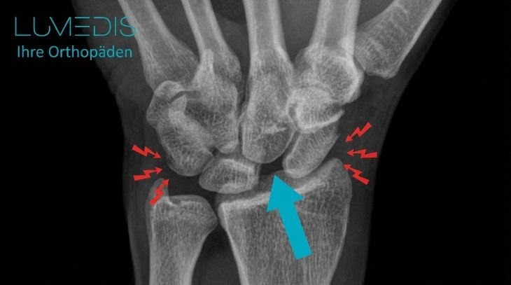 Röntgenbild einer scapholunäre Dissoziation (SLD) Röntgenbild einer scapholunäre Dissoziation (SLD)