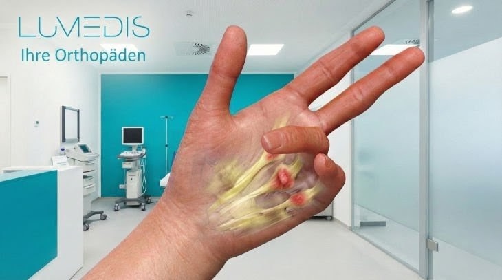 Morbus Dupytren - Lumedis - Handspezialisten Morbus Dupytren - Lumedis - Handspezialisten