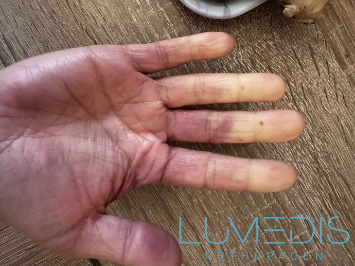Morbus Raynaud der rechten Hand Morbus Raynaud der rechten Hand