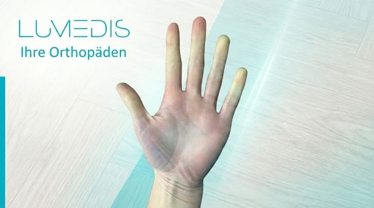 Morbus Raynaud in Start-Phase Morbus Raynaud in Start-Phase