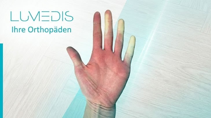 Morbus Raynaud in akuter Phase Morbus Raynaud in akuter Phase