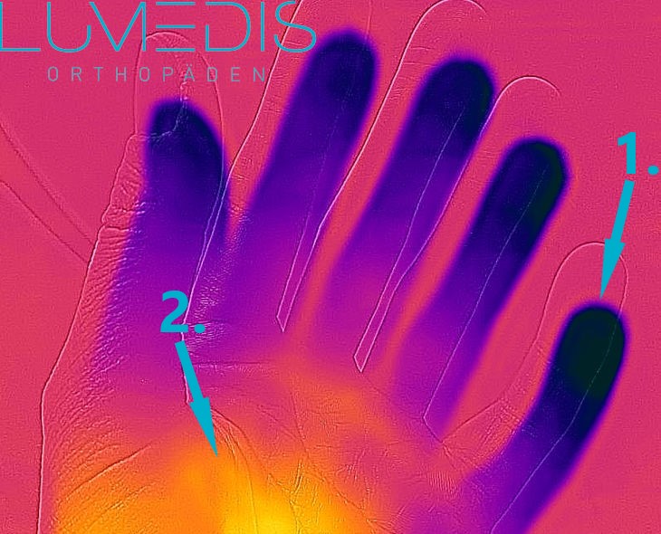 Raynaud Syndrom