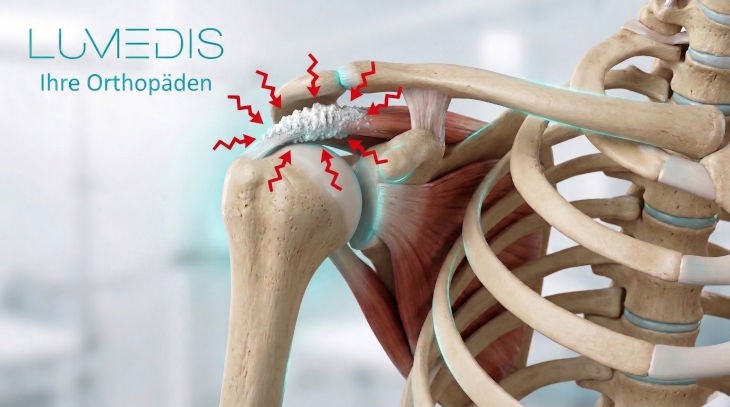 Abbildung einer Kalkschulter in der Supraspinatussehne Abbildung einer Kalkschulter in der Supraspinatussehne