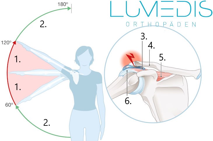 schmerzhafter Bogen (painful arc) bei einer Schleimbeutelentzündung der Schulter