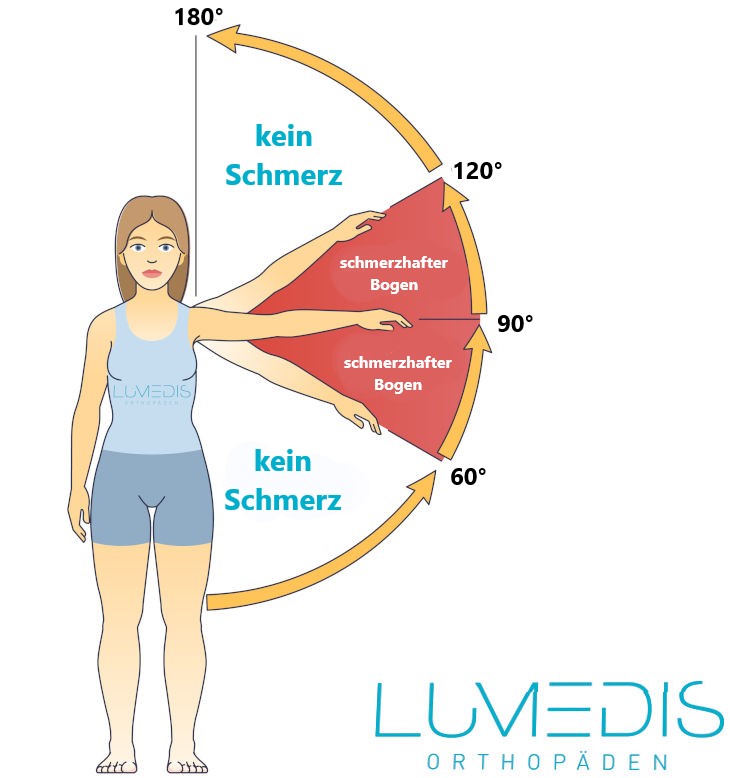 impingement-syndrom, painful-arc, schmerzhafter-bogen