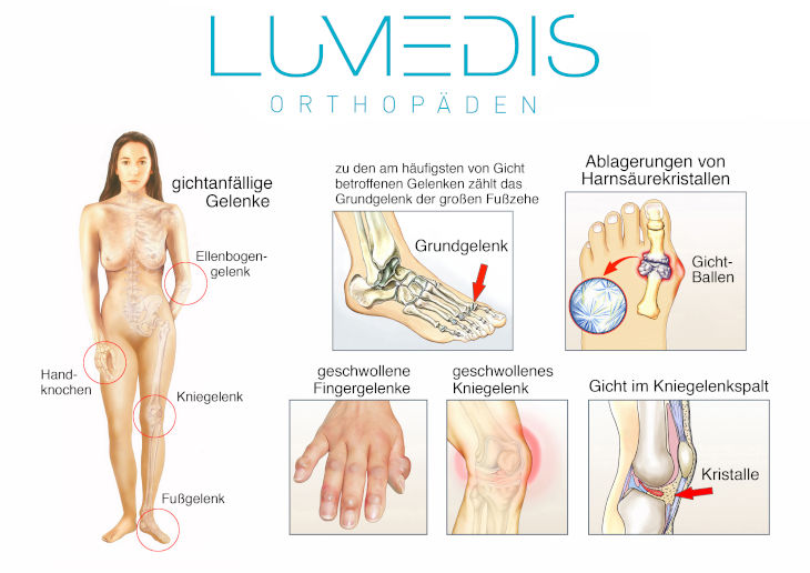 Abbildung von Gelenken, wo Gicht häufig auftritt