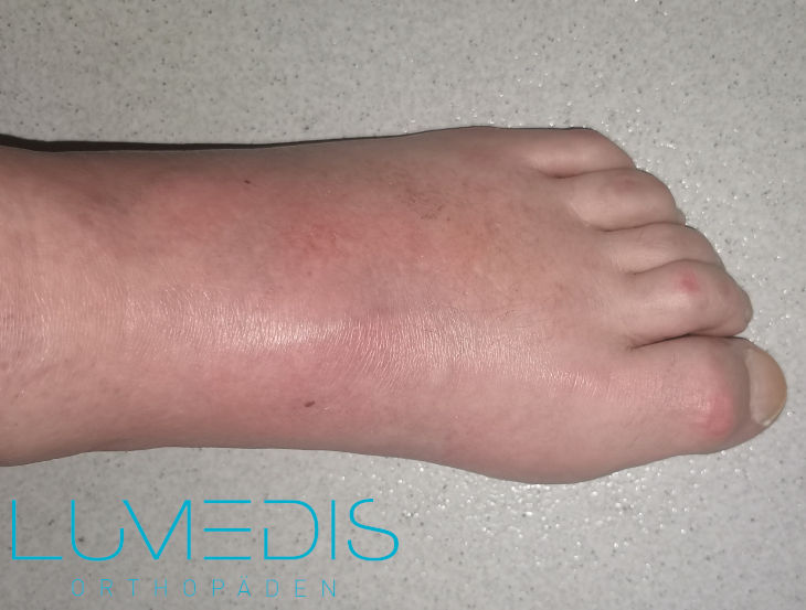 Gicht im Mittelfuß Gicht im Mittelfuß