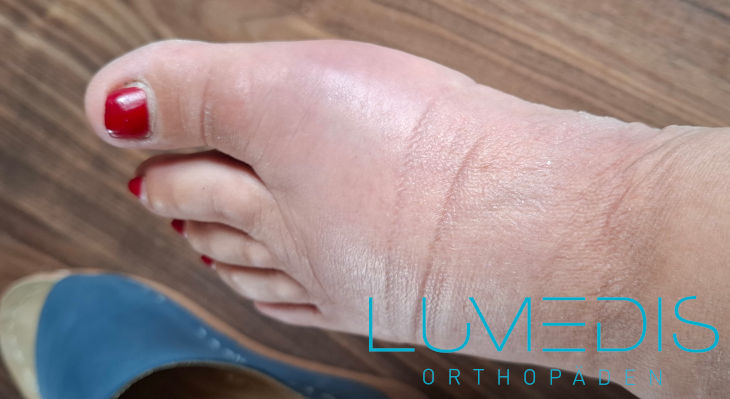 Gichtanfall im großen Zeh Gichtanfall im großen Zeh