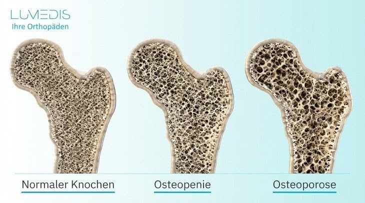 Abbildung normaler Knochen, Osteopenie und Osteoporose Abbildung normaler Knochen, Osteopenie und Osteoporose