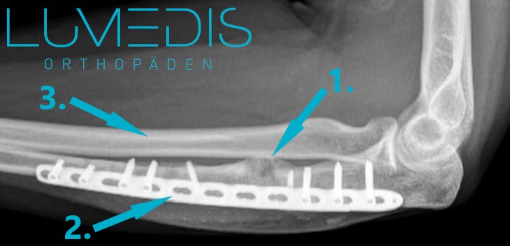 Pseudarthrose vor Behandlung (Ulna) Pseudarthrose vor Behandlung (Ulna)