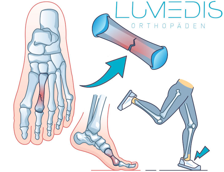 Ermüdungsbruch des 2. Strahls (Metatarsus), Stressfraktur, Schmerzen Fuß