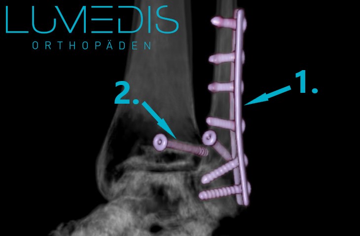 CT-Rekonstruktion einer Weber B-Fraktur CT-Rekonstruktion einer Weber B-Fraktur