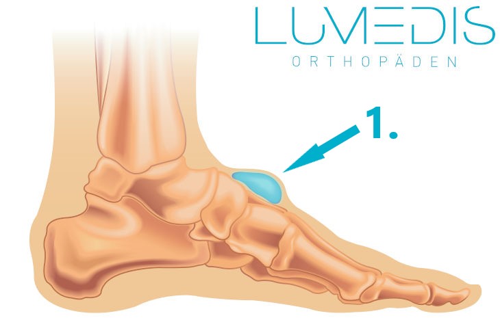 Überbein am Fußrücken Überbein am Fußrücken