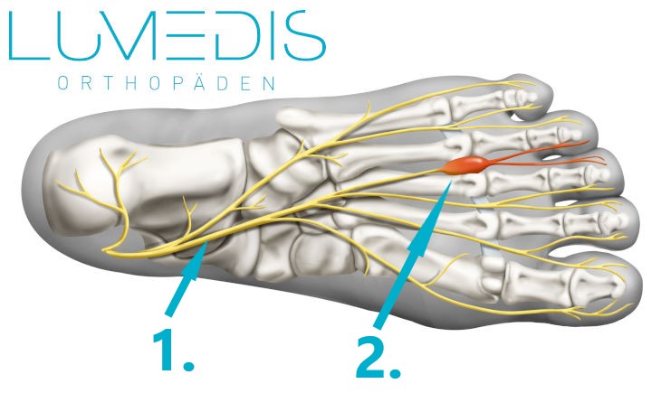 Abbildung eines Morton Neuroms