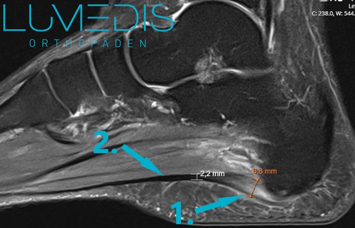 MRT einer schweren Plantarfasziitis MRT einer schweren Plantarfasziitis