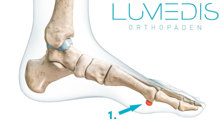 Sesambein unter dem großen Zeh Sesambein unter dem großen Zeh
