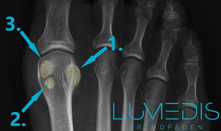 Röntgenbild eines geteilten Sesambeins unter der Großzehe Röntgenbild eines geteilten Sesambeins unter der Großzehe