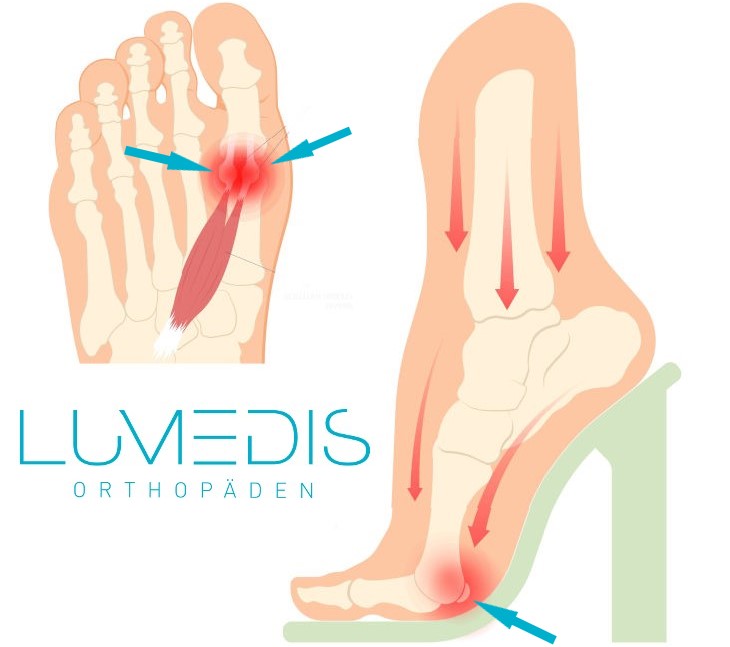 Entzündung des Sesambeins Entzündung des Sesambeins