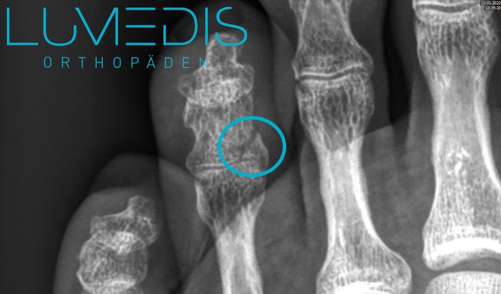 Knochenabsplitterung am Zeh Knochenabsplitterung am Zeh