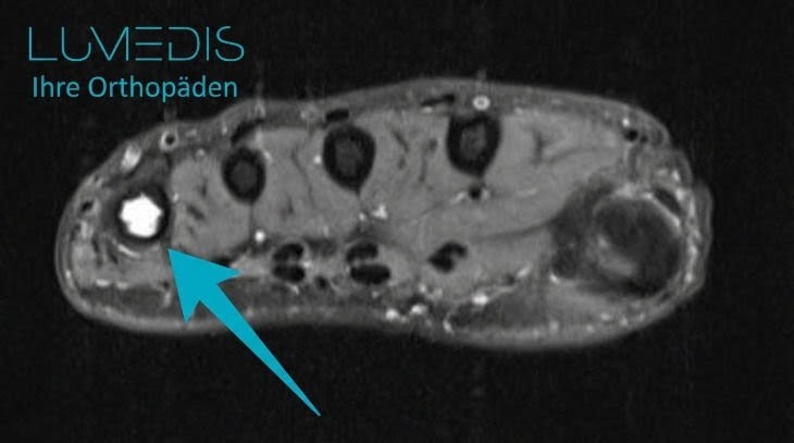 Zyste Fußknochen Zyste Fußknochen