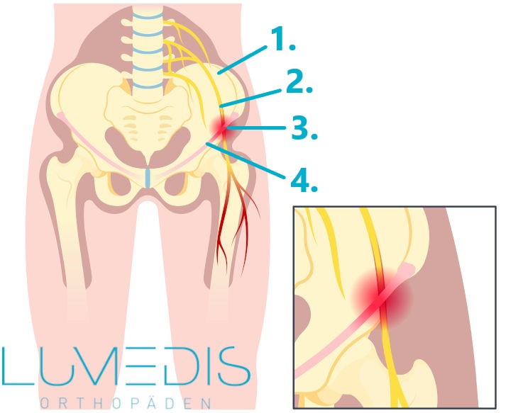 Meralgia paraesthetica mit Nervus cutaneus femoralis lateralis