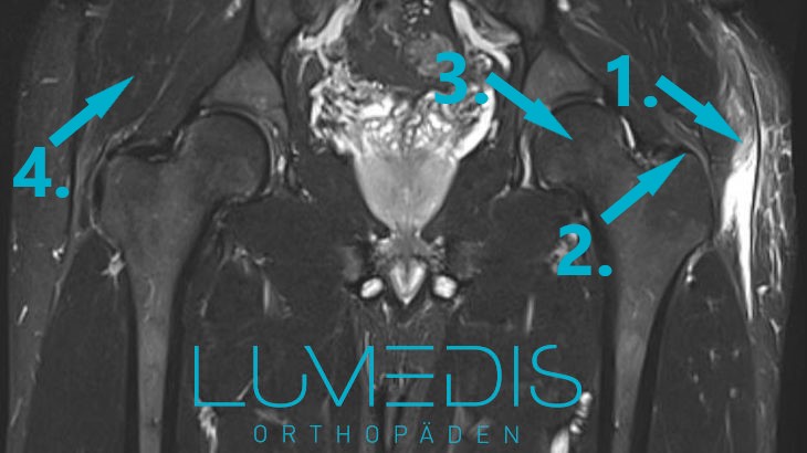 Muskelbündelriss M. gluteus medius / maximus