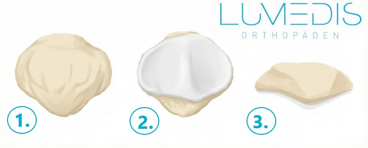 Anatomie der Kniescheibe Anatomie der Kniescheibe