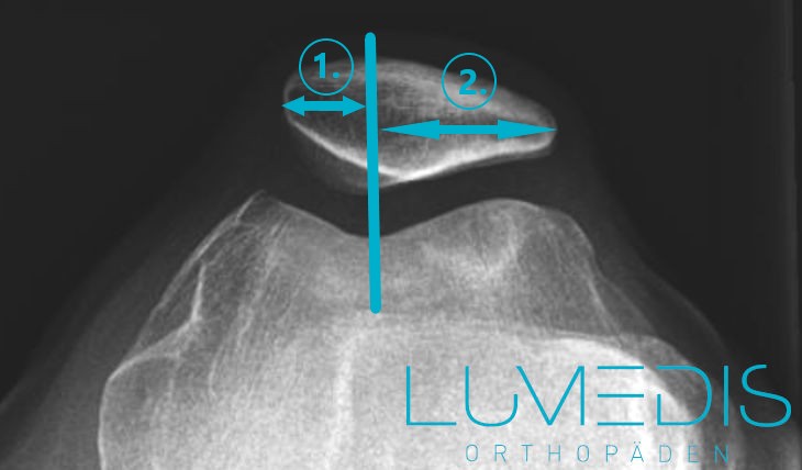Röntgenbild Defilee Patellalateralisation Röntgenbild Defilee Patellalateralisation