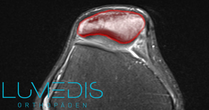 Jägerhutpatella farbig Jägerhutpatella farbig