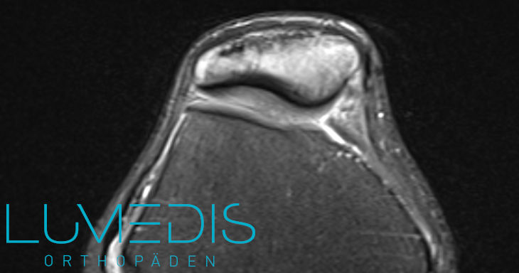 Röntgenbild einer Jägerhutpatella Röntgenbild einer Jägerhutpatella